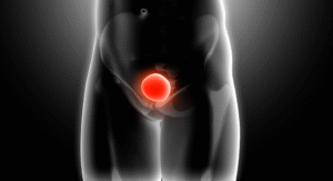 Curso de Cáncer de Vejiga